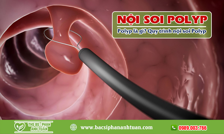 Nội soi polyp