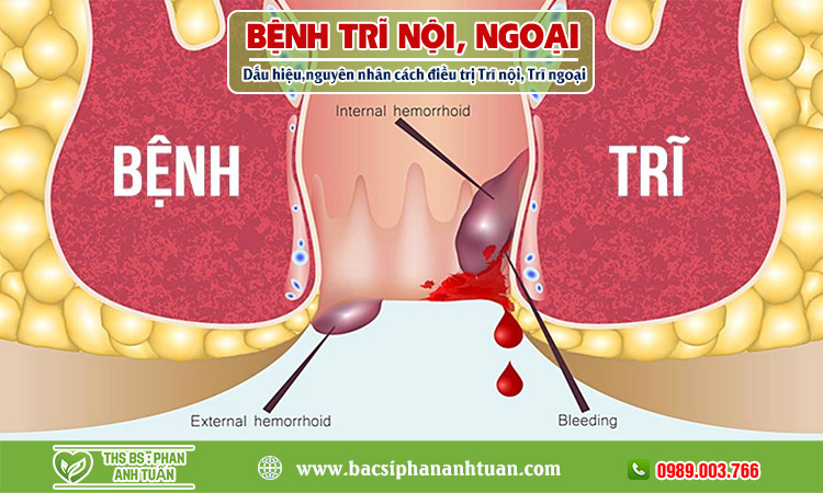 Bệnh trĩ