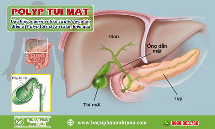 Polyp túi mật