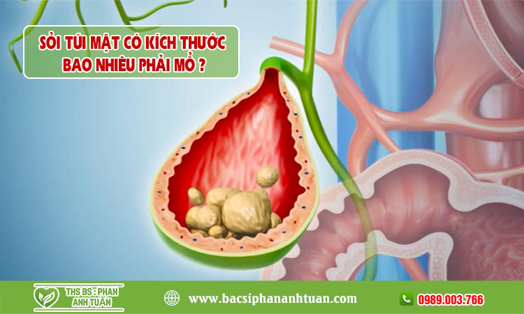 Sỏi túi mật kích thước bao nhiêu thì phải mổ?