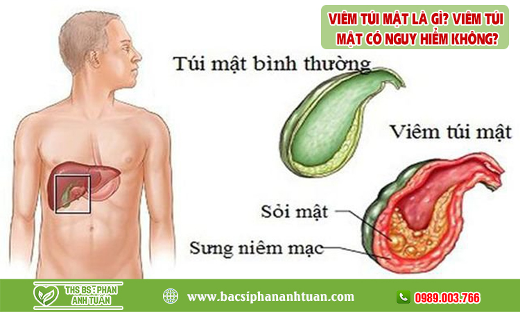 Viêm túi mật